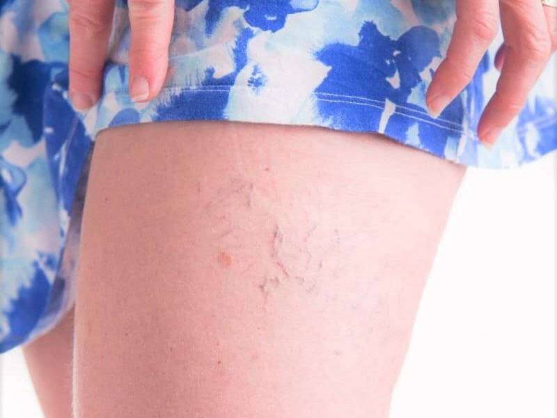 Varicose Vein Removal Long Island