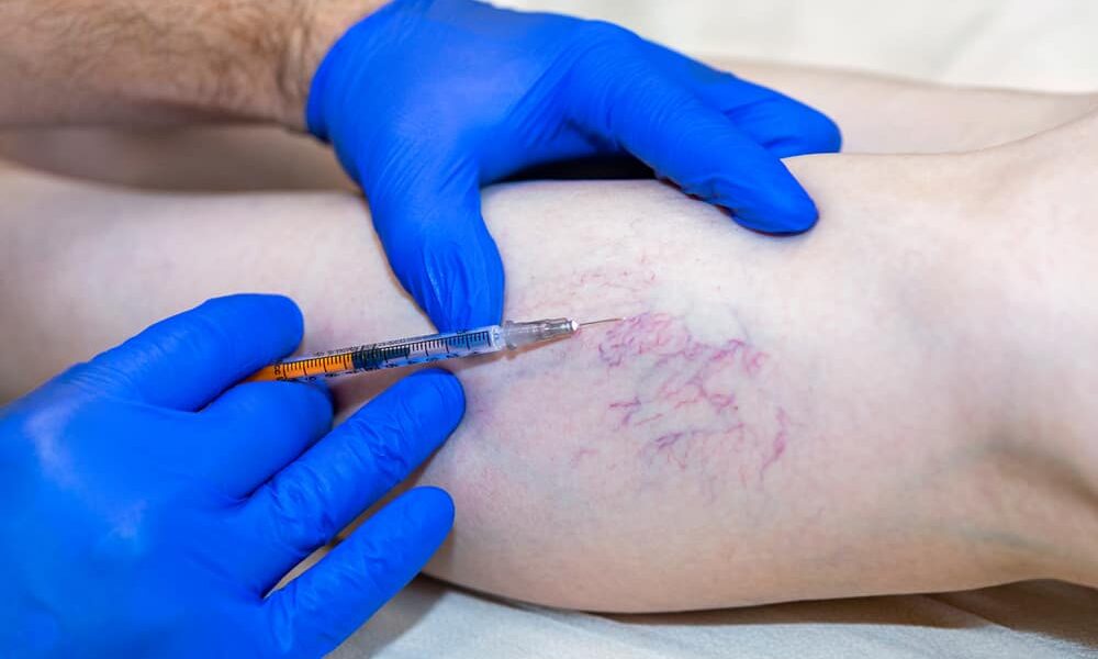 A person wearing blue medical gloves injects a syringe into the lower leg of another person with visible varicose or spider veins, illustrating vein removal Long Island experts often perform in NY clinics.