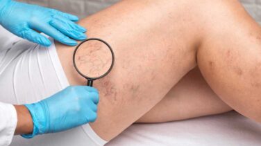 sclerotherapy treatment