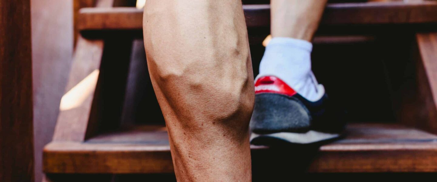 Long Island Varicose Vein Removal