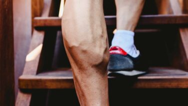 Long Island Varicose Vein Removal