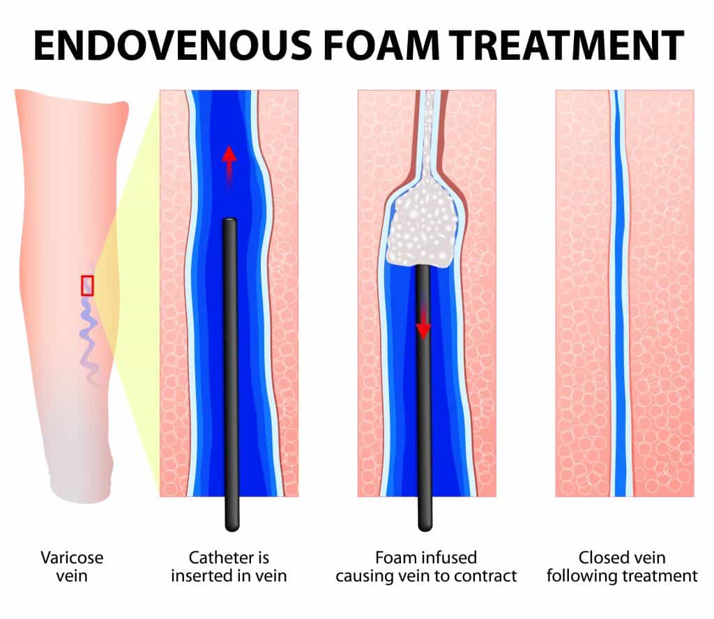 Endovenous Foam Treatment