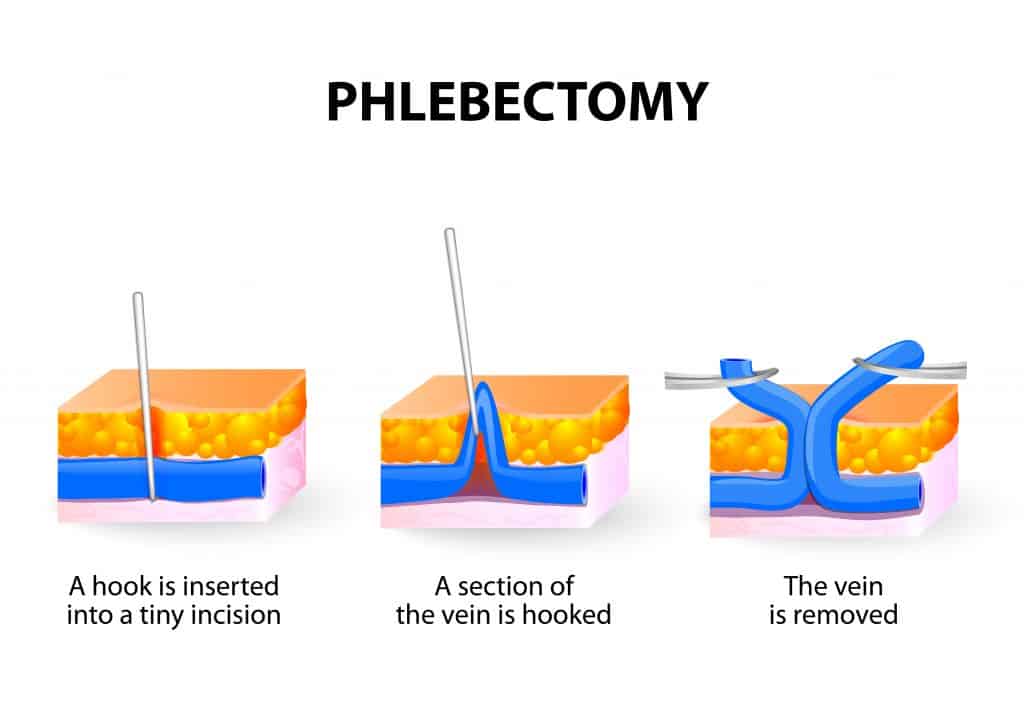 Phlebectomy