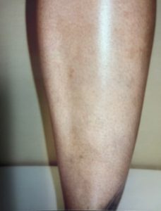 Varicose Vein Removal After