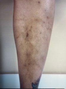 Varicose Vein Removal Before