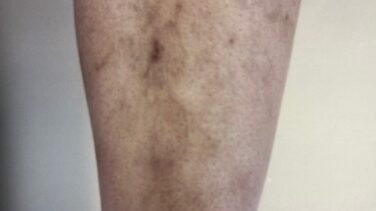 Varicose Vein Removal Before