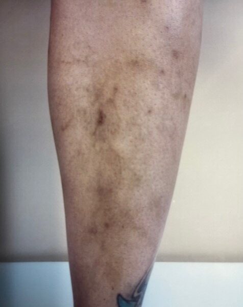 Varicose Vein Removal Before