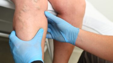 Varicose Vein Removal