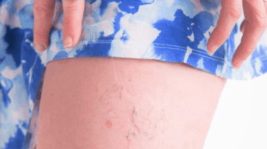 varicose veins on a female woman's leg