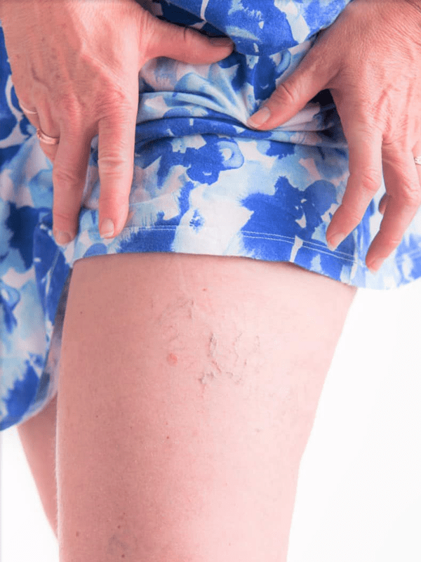 varicose veins on a female woman's leg