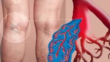 Varicose veins with illustration of vein