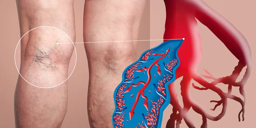 Varicose veins with illustration of vein