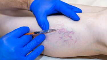 A person wearing blue medical gloves injects a syringe into the lower leg of another person with visible varicose or spider veins, illustrating vein removal Long Island experts often perform in NY clinics.