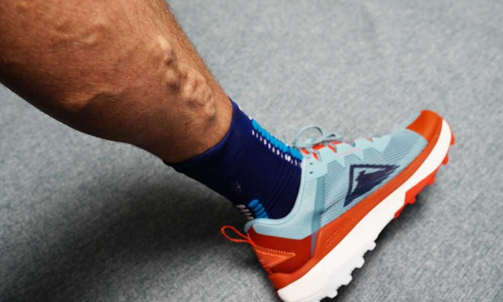 runner with varicose veins