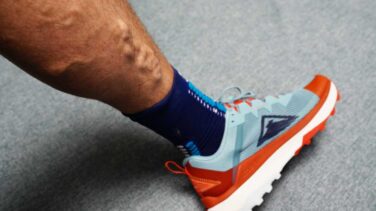 runner with varicose veins