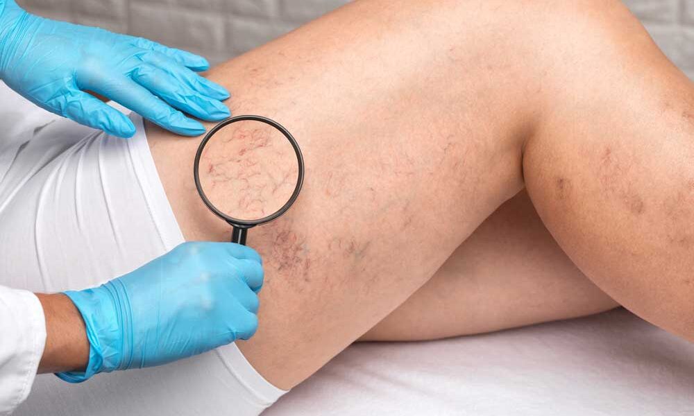 sclerotherapy treatment