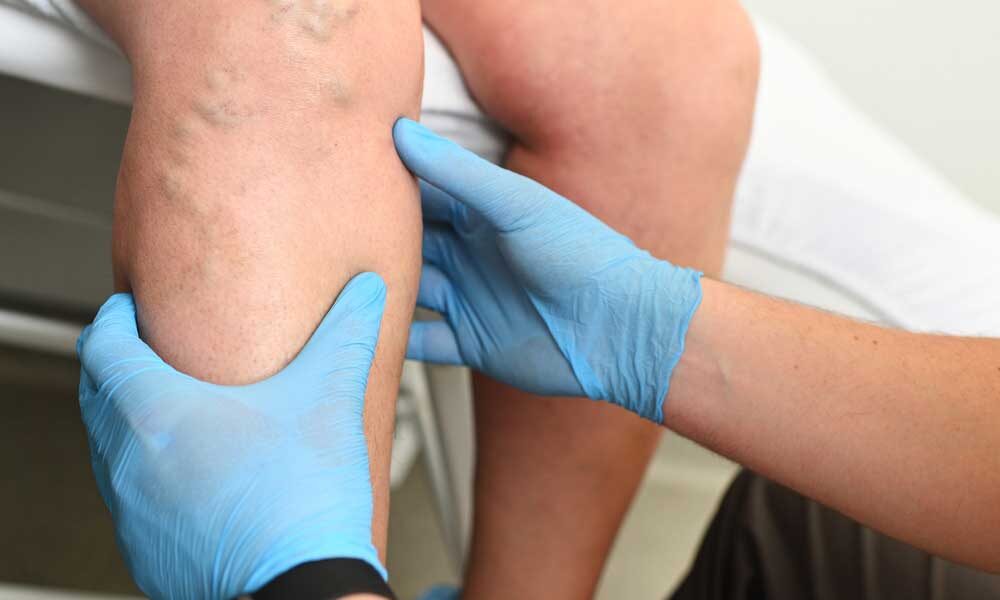 spider vs varicose veins
