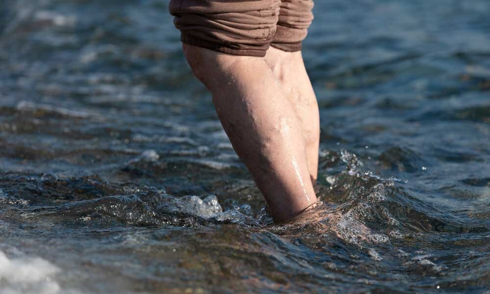 patient with visible varicose veins