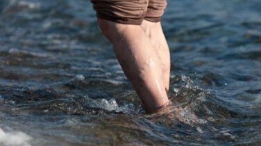 patient with visible varicose veins